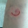 Still wondering what made me this nice tattoo on my leg... #crash #DddW #handlebar?